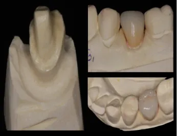 Figura 7. Coroa provisória confeccionada por técnica direta com resina acrílica.