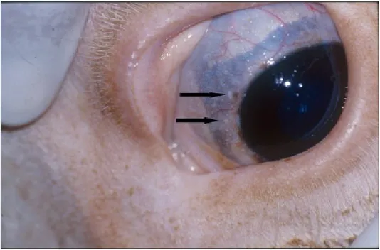 Fig. 2: Small nodules (Besnoitia cysts) on the limbal area of the scleral conjunctival  membrane.
