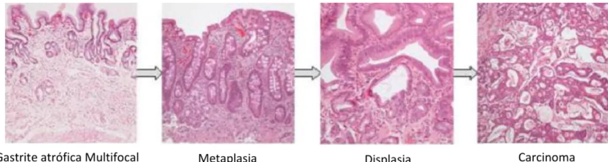 Figura 10 – Alterações neoplásicas que ocorrem na mucosa gástrica, promovendo o  desenvolvimento de CG