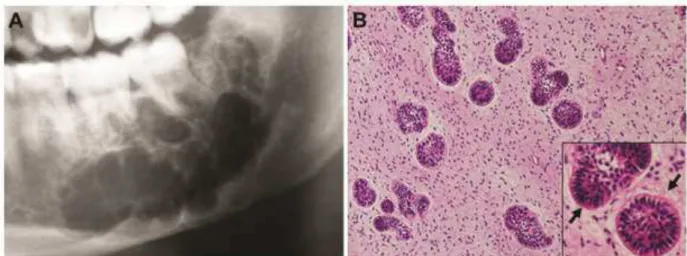 Figura 3: Aspectos radiográfico e histopatológico de fibroma ameloblástico. (A)  Imagem radiolúcida multilocular com bordas escleróticas em região posterior de  mandíbula