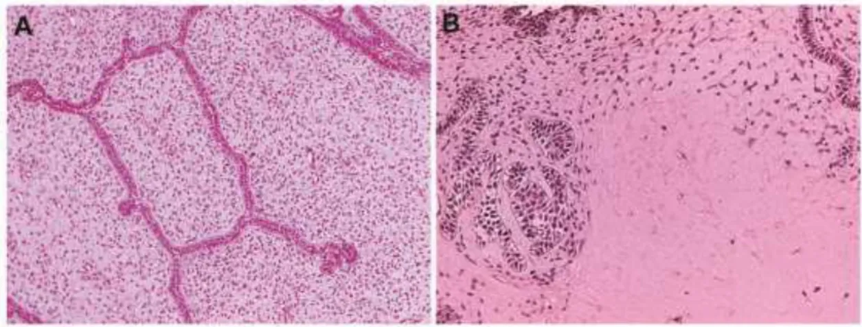 Figura  5:  Achados  histopatológicos  em  fibrodentinoma  ameloblástico.  (A)  Os  cortes  histológicos  corados  em  hematoxilina-eosina  revelam  finos  e  longos  cordões  de  epitélio  odontogênico  dispostos  em  um  tecido  conjuntivo  frouxo,  rica