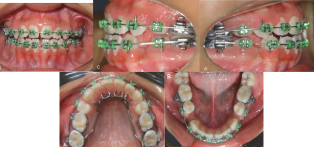 Figura 5-Fotos mostram fase de alinhamento e nivelamento após as extrações, e a  instalação da grade palatina fixa 