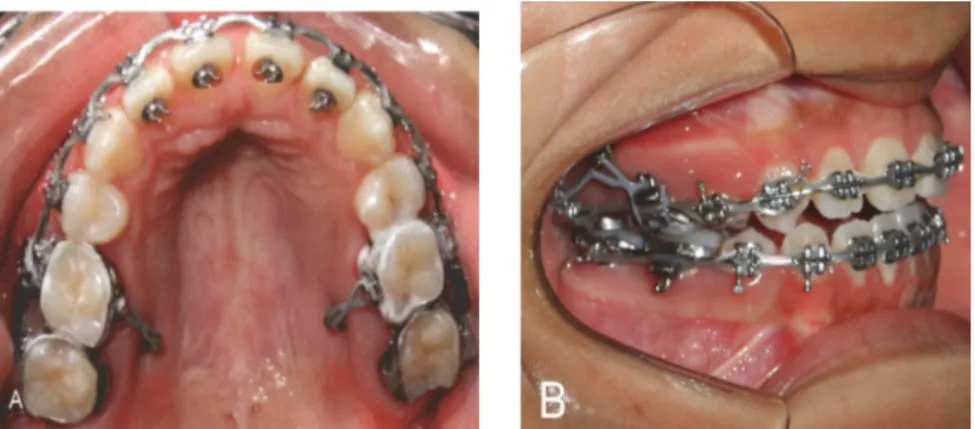 Figura 9-Ganchos Kobayashi nos incisivos centrais superior, inferior e caninos superior  para colocação dos elásticos, finalizando o fechamento da mordida aberta anterior e 