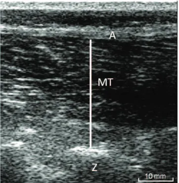 Table 1 shows the PBU and the variation in lumbar mul- mul-tifidus muscle thickness values of both groups