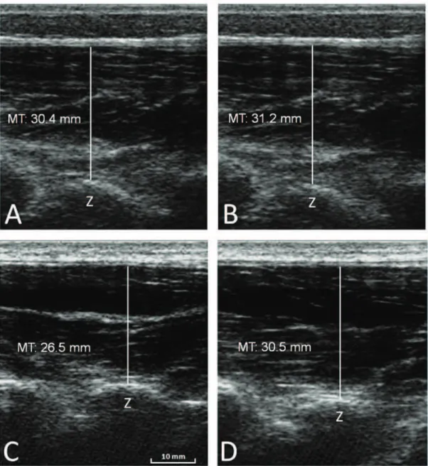 Figure 3. Ultrasound images of the multiidus muscle at rest (A,C) and during the PBU test (B,D) of a representative athlete from the CON (A,B)  and from the TLS (C,D) groups, respectively