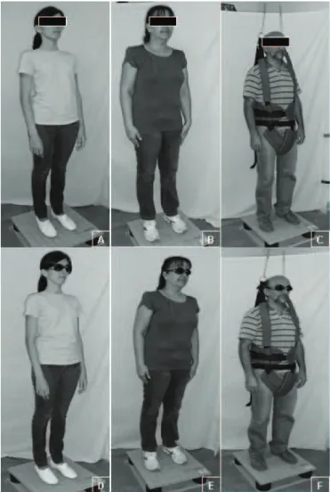 Figure 2. Evaluation of CoP displacement in doble leg-stance (YG,  MAG and EG) with full (A, B and C) and partial vision (D, E and F).