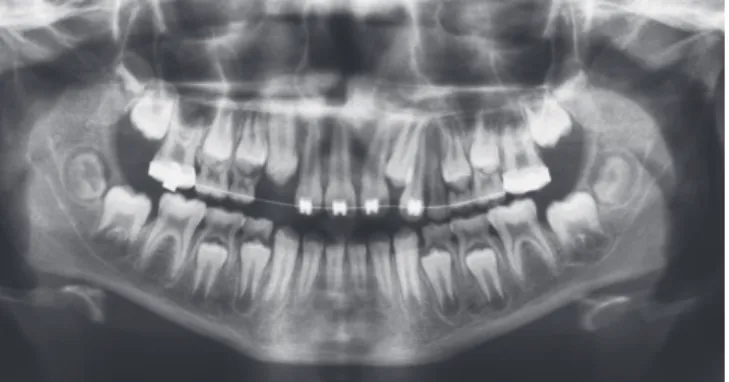 Figura 01- Radiografia panorâmica ao início do tratamento. 