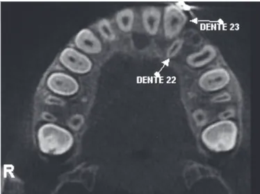 Figura 04: Posição Radicular Inicial da transposição dentária 