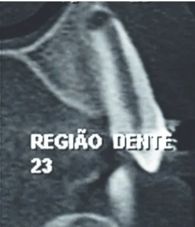Figura 9: Visão do dente 23 distalizado para sua posição correta 