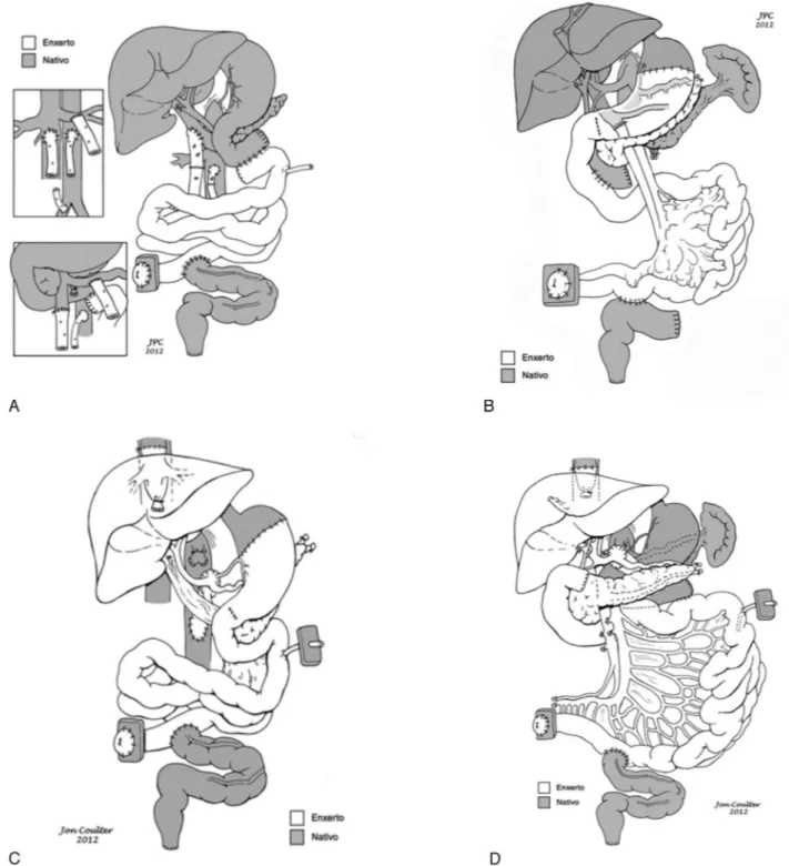 Figure 1 - A- Intestinal loop lengthening, based on the longitudinal division of the intestine