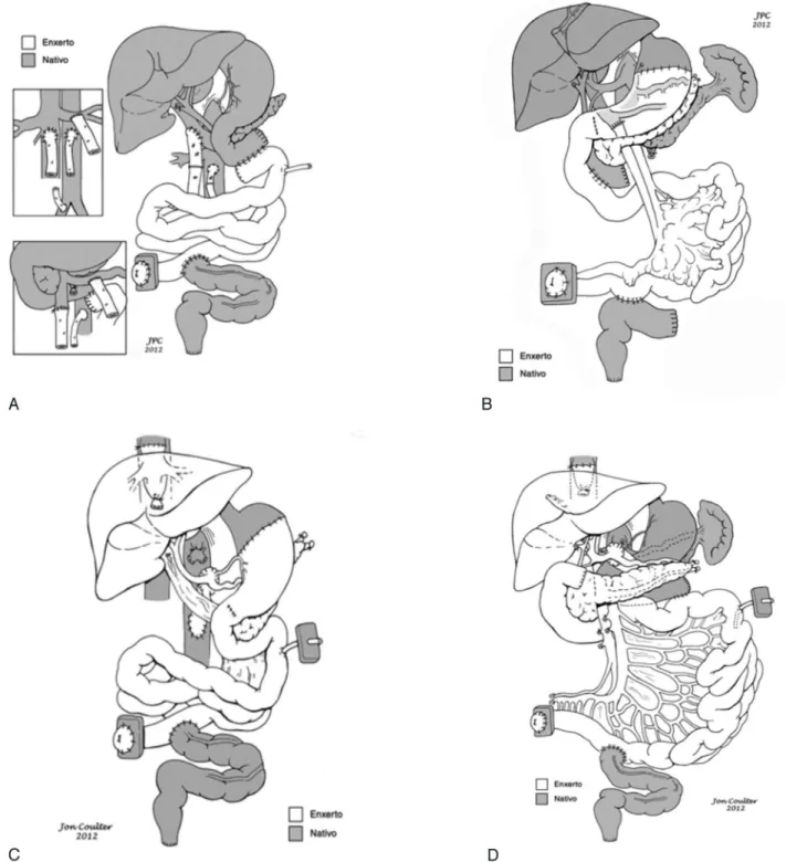 Figure 1 - A- Intestinal loop lengthening, based on the longitudinal division of the intestine