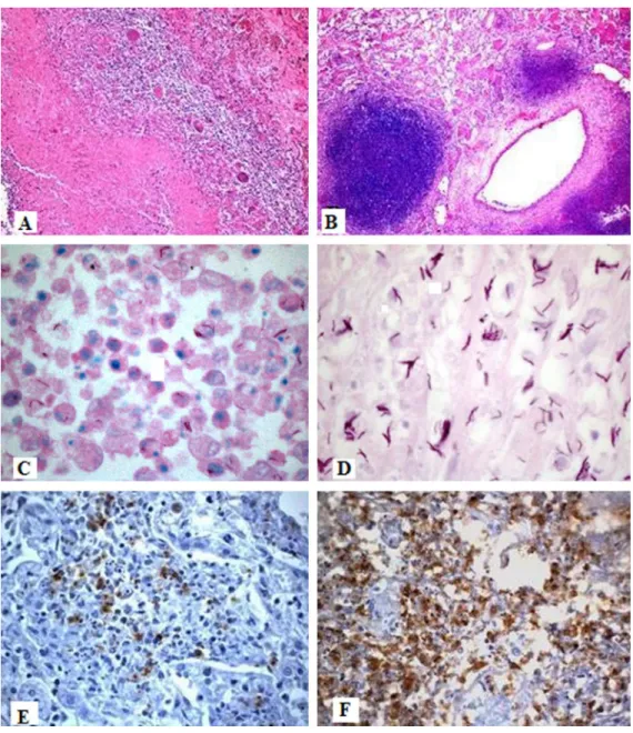Figure 1 - Lung granulomas in TB and TB/AIDS groups. A) well-organized granuloma with central caseous necrosis and a peripheral rim of lymphocytes and Langhans-giant cells (TB group, H&amp;E, 25x); B) Poorly formed granulomas with extensive necrosis, littl