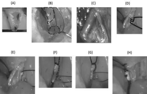 Figure 1 - Temporary occlusion of the right carotid artery and catheterization of the external right carotid artery