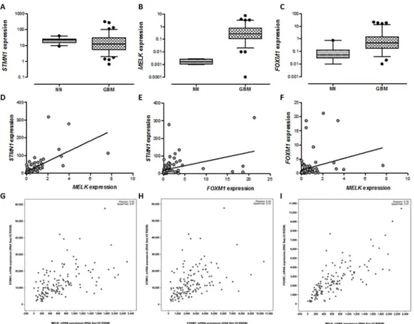 Figure 1.  STMN1 ,  MELK  and  FOXM1  expression levels in glioblastoma (GBM) and non-neoplastic brain tissue samples (NN)