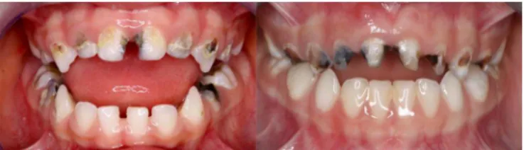 Figure 1.Two 5-year-old children with early childhood caries, with a history of missing  scheduled appointments.