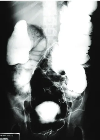 Figure  2.  Colonoscopy  showing  many  polyps.  Endoscopic  resection for the anatomopathological study.