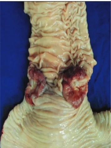 Figure 5. Detail of the colic tumor adjacent to the dilated segment. 