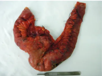 Figure 1.  Resected terminal ileum segment, with apparent area of  secondary graft.