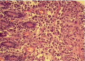 Figure  4.   Histopathological  aspect  of  the  lymphoma  in  the  terminal ileum.