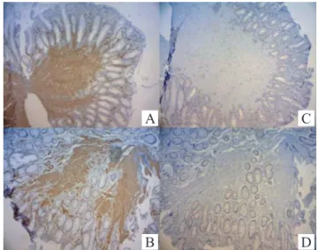 Figure  2.  Immunohistochemical  blades  of  specimens  endoscopically resected via rectum showing positivity for smooth  muscle actin (case 1 - A and case 2 - B) and negativity for CD117  (c-kit) (case 1 - C and case 2 - D).