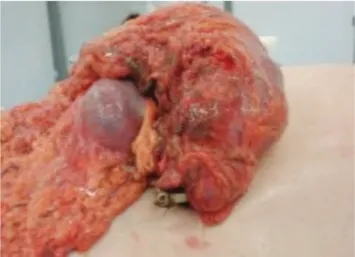 Figure 2.  Colocutaneous ixation tube ixed to the intestinal segment.