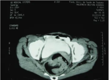 Figure  2.  Vegetating  tumor  of  the  sigmoid  exteriorized  through  the anus.