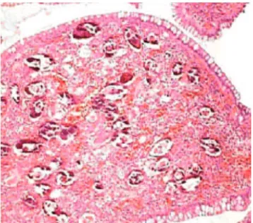 Figure 1. Large and fragile lesion in the anterior rectal wall 6 cm  from the anal margin.