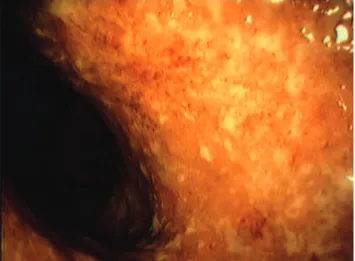 Figure 5. Colonoscopy showing edema, hyperemia and erosions  throughout  the  colons,  which  is  compatible  with  the  active  inlammatory bowel disease.