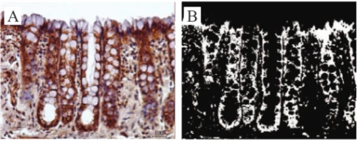 Figure 1A exemplii es the expression of β-catenin  protein in the mucosal layer of the colon with fecal  stream  after  18  weeks  of  bypass,  while  Figure  1B  shows the quantii cation of protein in the same i eld  shown by Figure 1A, in binary image, u