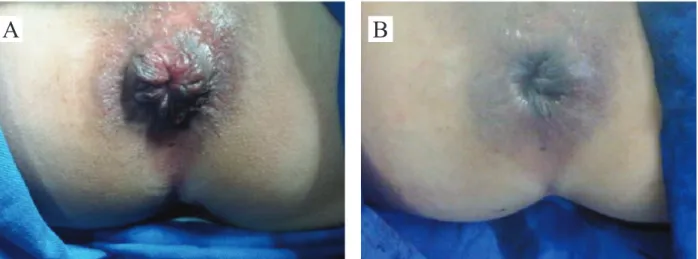 Figure 2. (A) Preoperative aspect of patient with hemorrhoidal disease. (B) Immediate postoperative of the same patient submitted to the  doppler-guided transanal hemorrhoidal dearterialization with mucopexy.