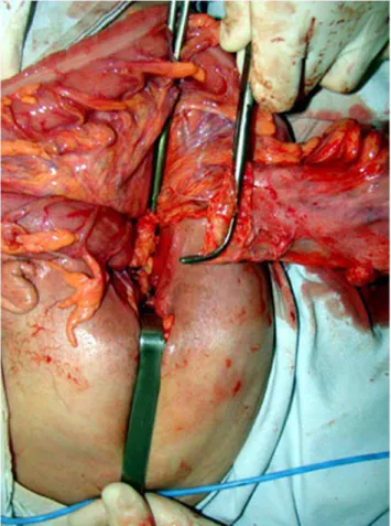Figure 1. Full-thickness rectal procidentia. Figure 2. Rectum and colon dissection with mesocolon ligature.