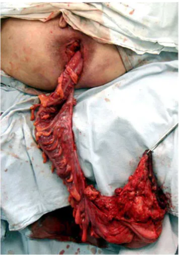 Figure 4. Colonic segment prepared for the anastomosis.