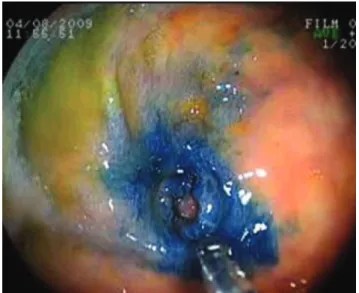 Figure 2. Small rectal diverticulum with size of 0.7 cm, central  depression and elevated margins in the posterior wall of the rectum.