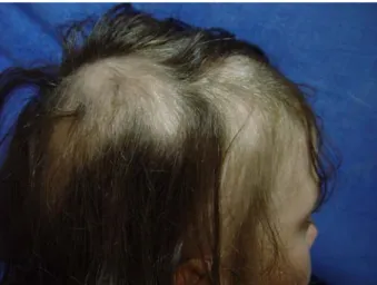 Fig. 6 – Criança com forma extensa de alopecia areata (S3) em fase de repovoamento após terapêutica com  imunos-supressores sistémicos.
