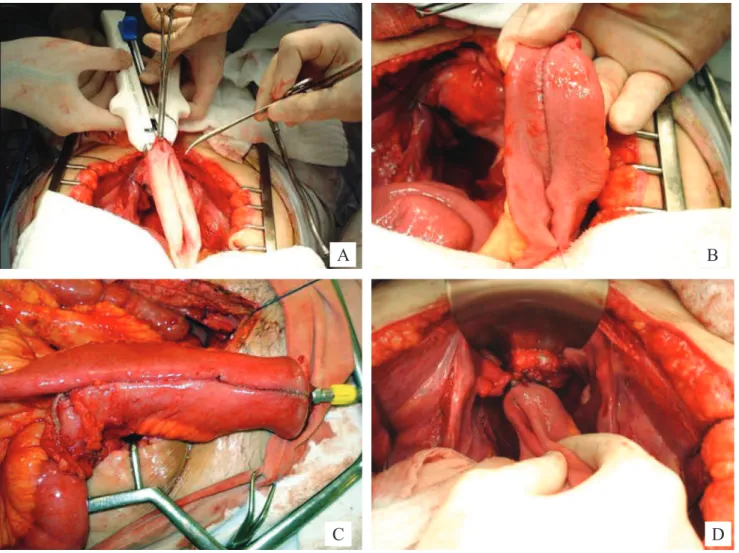 Figure 2. Creation of J-pouch. (A) First linear stapling. (B) Ileal J-pouch. (C) Preparing to anastomosis