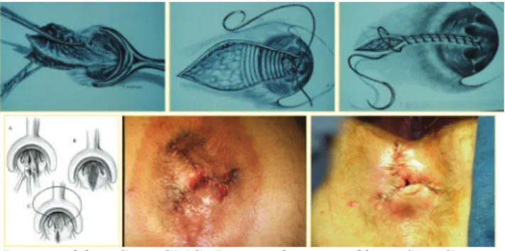 Figure 2. Surgical technique. Final result of hemorrhoidectomy  by Ferguson technique