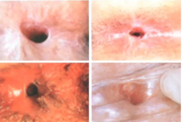 Figure 5.  Detail  from  previous  igure  enlarged,  showing  the  incidence  of  surgical  complications  (87  cases;  3.1%)  in  2,840  patients submitted to hemorrhoidectomy.