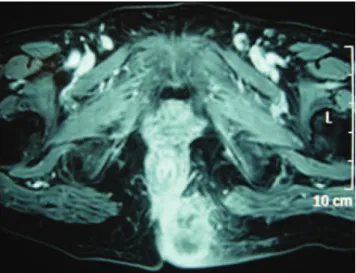Figure 1. Presentation of metastasis from adenocarcinoma  Figure 2. Pelvic nuclear magnetic resonance.