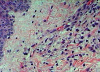 Figure 1. Optical microscopy with hematoxylin-eosin stain showing  cutaneous metastases of signet-ring cell colorectal adenocarcinoma.