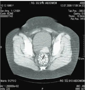 Figura 3. Computed tomography showing rectal nodules.