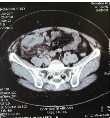 Figure 1. Abdominal computed tomography showing wall  thickening in the cecum and ascending colon with stranding  of mesenteric fat and adjacent peritoneum, compatible with  neoplastic lesion.