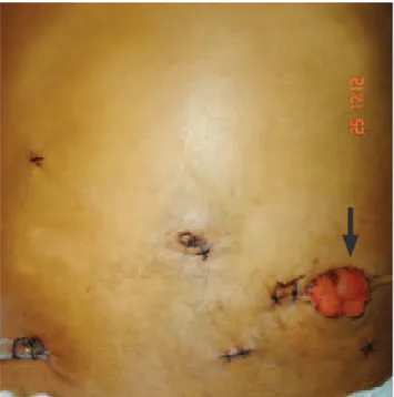 Figure 1. Image of the anterior abdominal wall. Incisions for the  trocars, wet colostomy (arrow) in the left iliac fossa and pelvic  drain in the right iliac fossa.