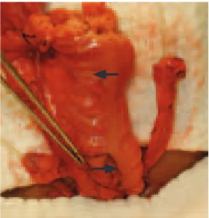 Figure 2. Exteriorization of right and left ureters (arrows) and  colon loop, in the left iliac fossa incision, for the extracorporeal  ureterocolonic anastomosis.