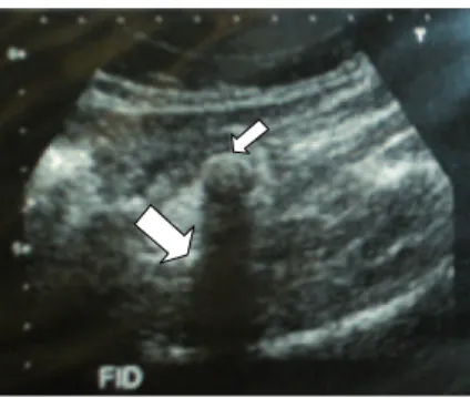 Figure 1. Ultrasonography of the patient, showing fecalith  (smaller arrow) in the right iliac fossa