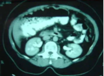 Figure 1. Abdominal tomography showing colonic dilatation.