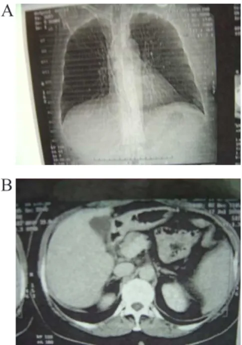 Figure 7. (A) thorax X-ray and (B) abdominal tomography with  normal aspect after chemotherapy and hormonal therapy.