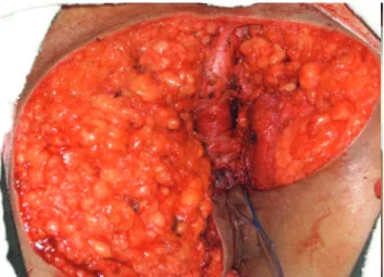 Figure 2. Panoramic view of the bleeding area of surgical  resection and seton insertion to concomitantly approach  the anal istula.