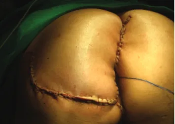 Figure 4. Panoramic view of the immediate result of the surgery,  after using cutaneous laps.