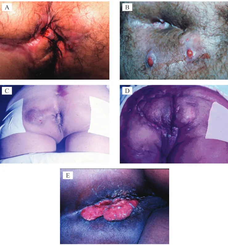 Figure 8. Some morbid entities that should be considered as differential diagnoses of hidradenitis suppurativa: Crohn’s disease (A), multiple  non-speciic anorectal istulas (B), non-speciic perianal istulas (C), cutaneous tuberculosis (D) and lymphogranulo