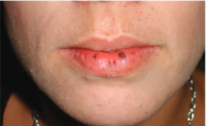 Figure 3. Characteristic mucocutaneous melanic pigmentation.